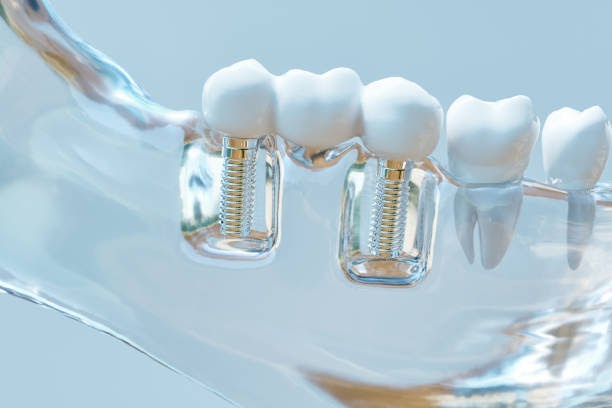 Dental Implants in Elk Grove Village, IL
