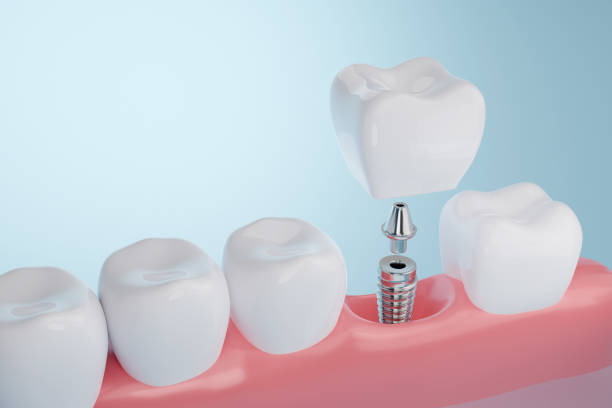Dental Implants at Dr. Brian Homann, DDS