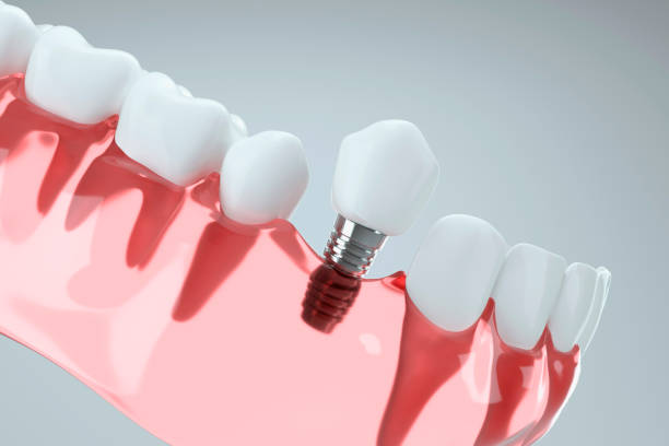 Rediscover Your Smile with Dental Implants in Schaumburg, IL