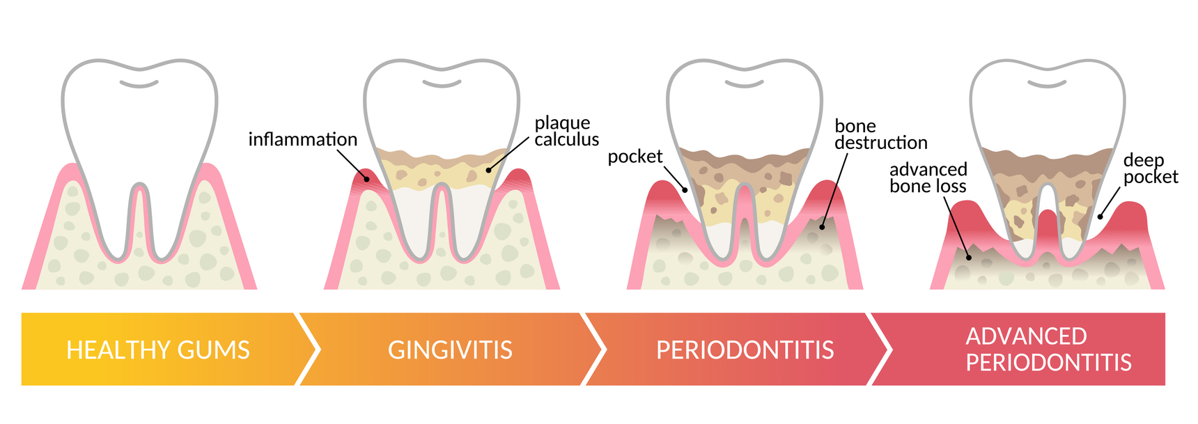 The stages of gum disease, from healthy gums to advanced periodontitis.