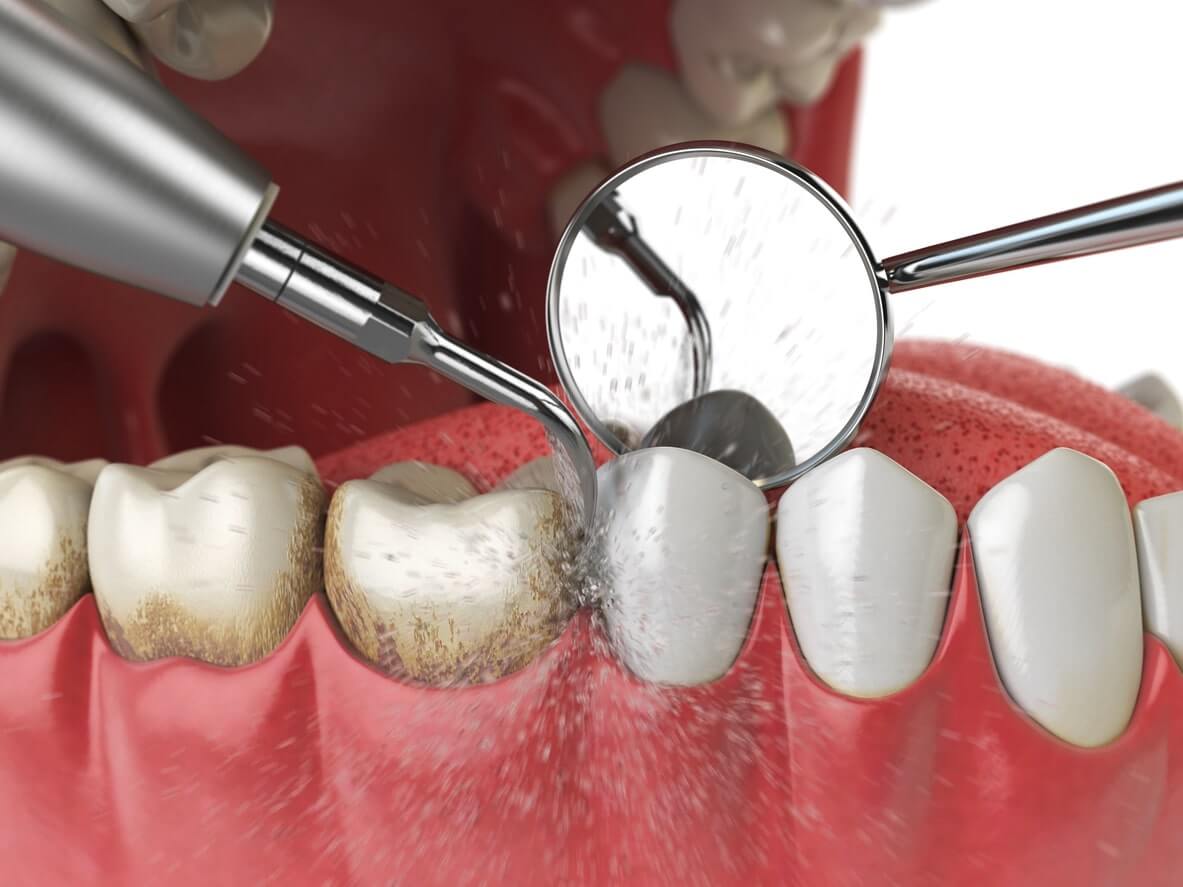 An ultrasonic dental device being used to remove plaque and bacteria from human teeth. 